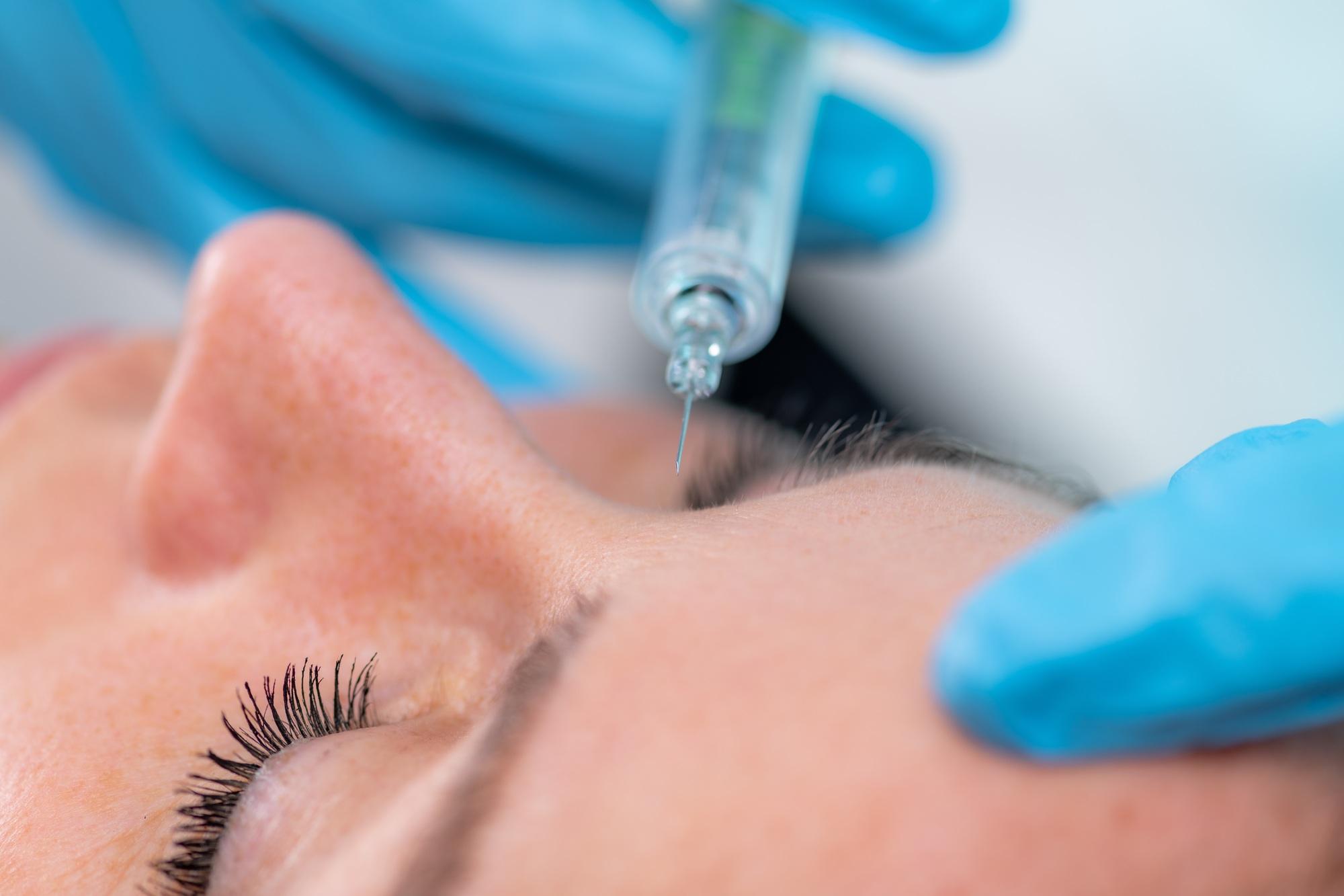 Treating Forehead Lines with Hyaluronic Acid